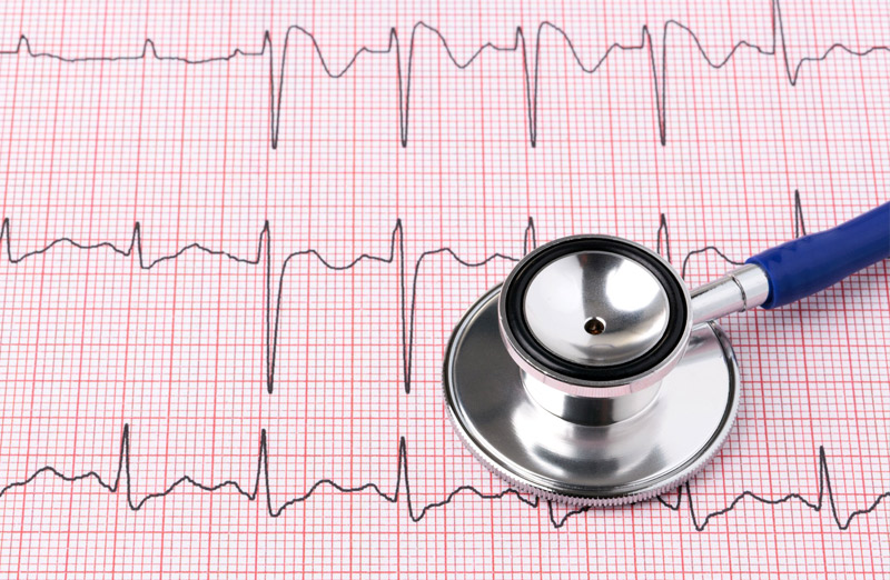 Как проводится ЭКГ?