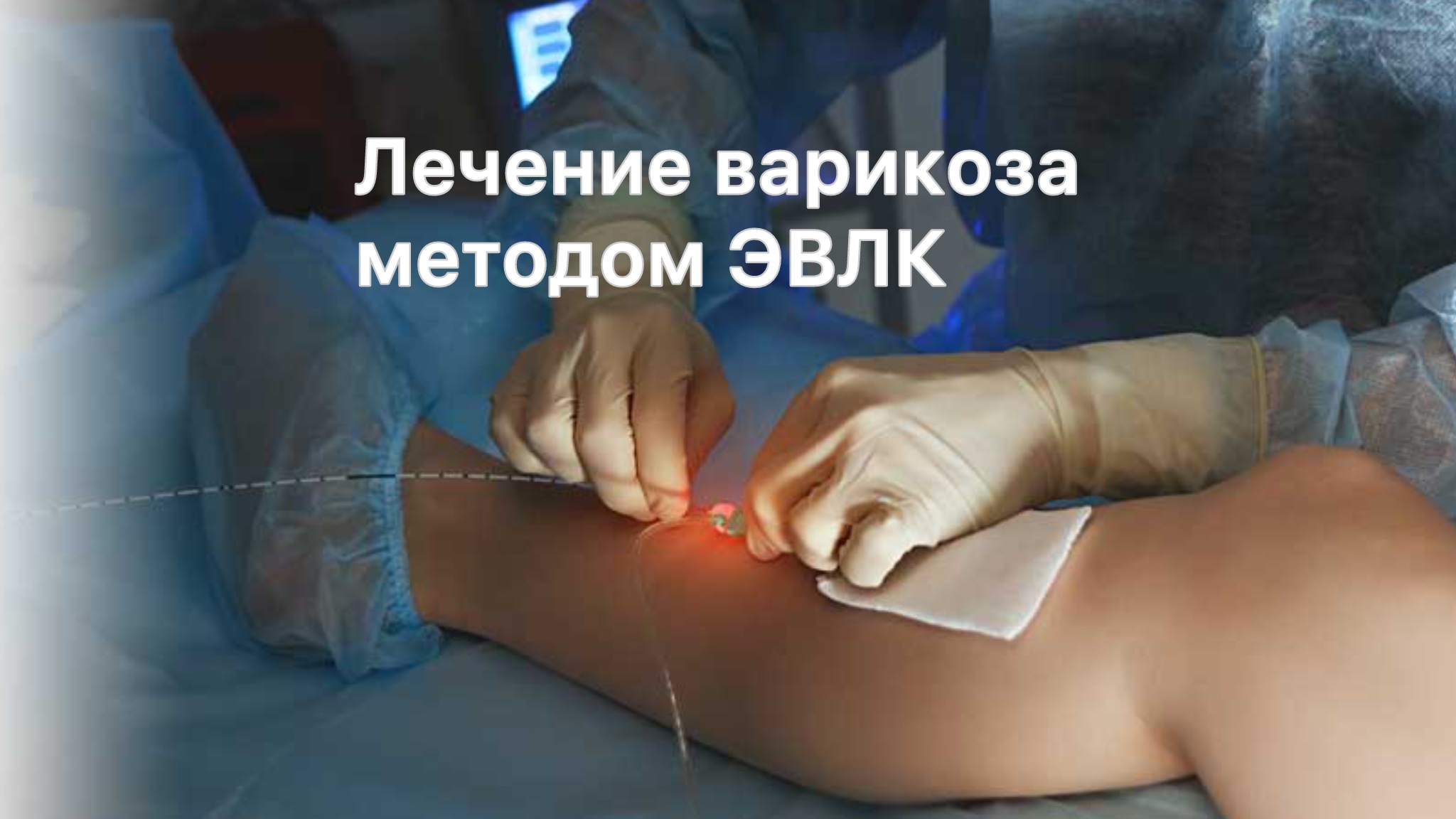 Лечение варикоза методом ЭВЛК
