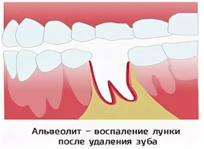 Заживление лунки зуба после удаления