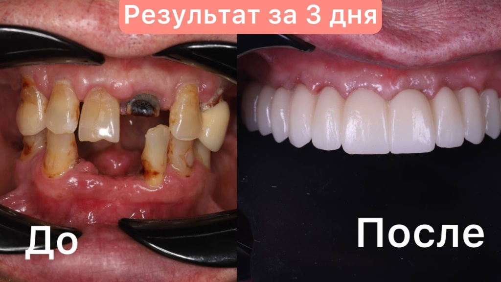 Восстановили ВСЕ зубы за 3 дня