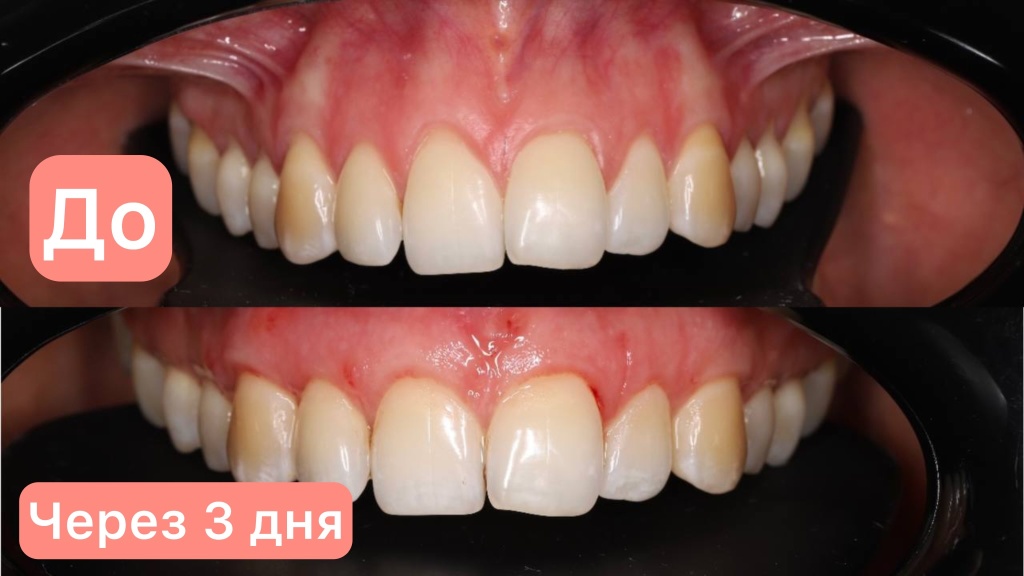 Пластика рецессии десны