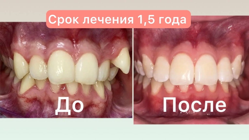 Ортодонтическое лечение ДО/ПОСЛЕ