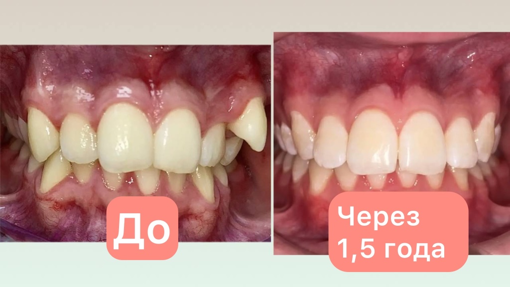 Ортодонтическое лечение ДО/ПОСЛЕ