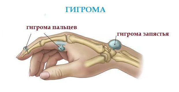 Гигрома