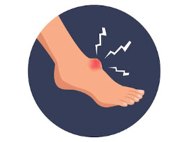 Липома