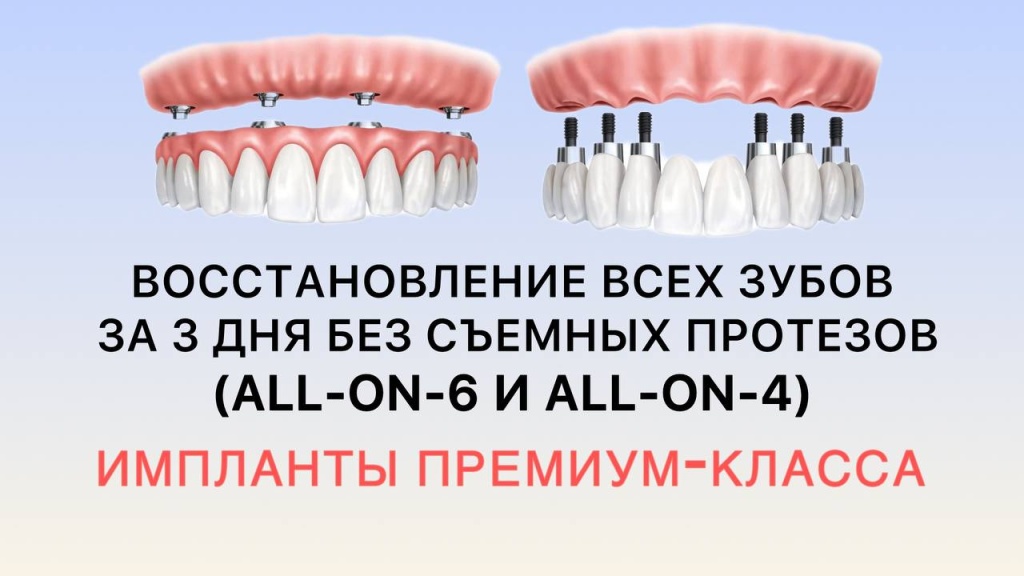 all-on-6 и all-on-4