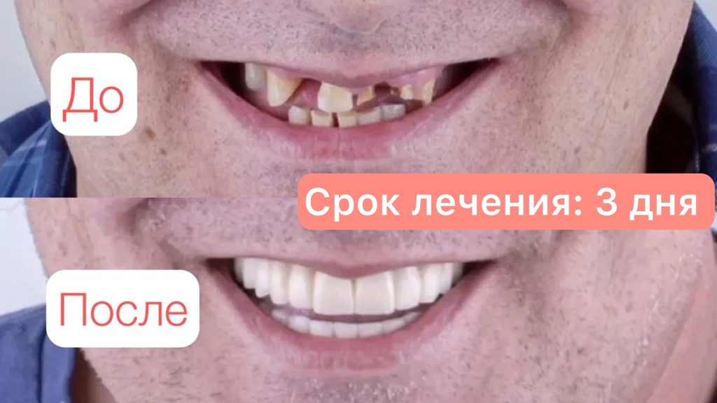 Протезирование на имплантах All-on-6