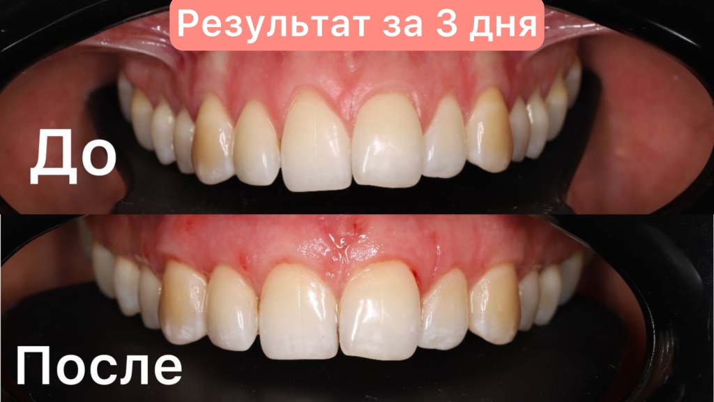 Пластика рецессии десны