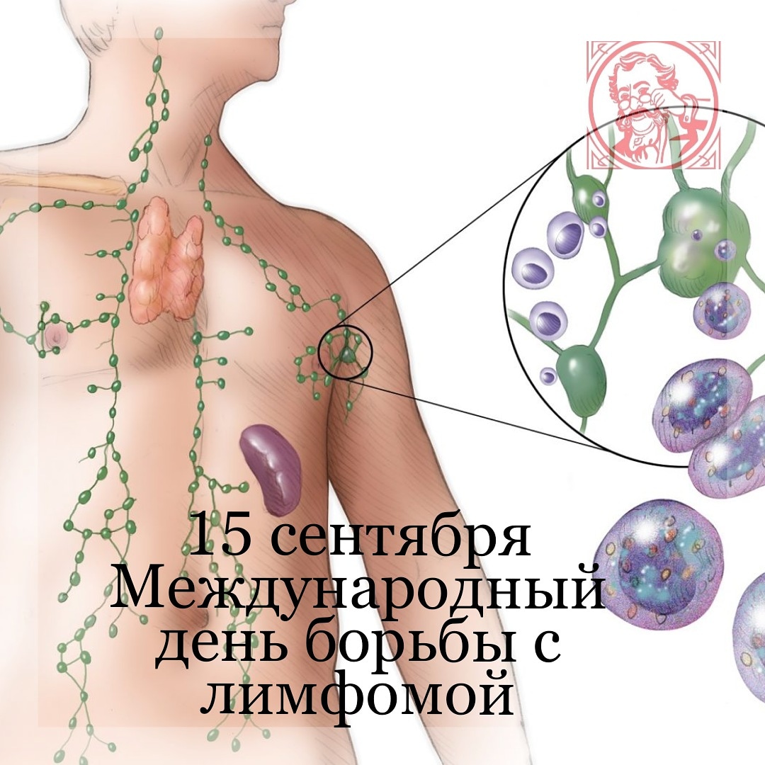 15 сентября Международный день борьбы с лимфомой!