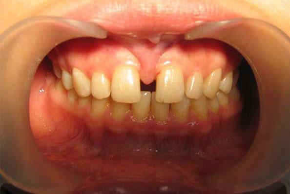 Кусание губ после анестезии