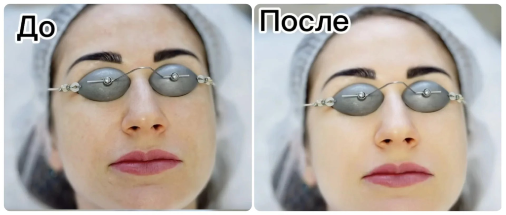 Омоложение лица фото до после, отзывы омоложение лица до после, лазерное омоложение лица до и после, лазерное омоложение фото