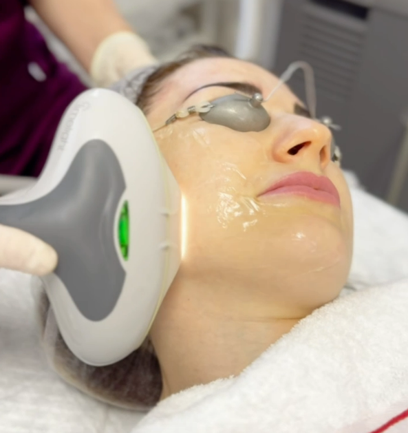 Фотоомоложение Xeo Cutera Lime Light в Балашихе, Фототерапия кожи Lime Light в Балашихе, Омоложение в Балашихе, Cutera в Балашихе