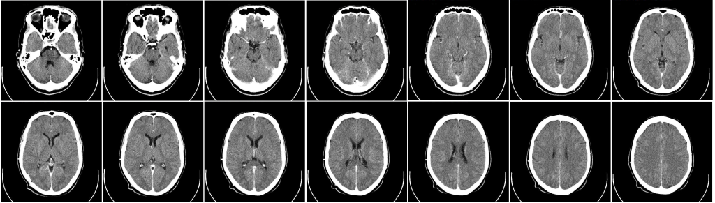 Компьютерная томография (КТ) Головного мозга (ГМ)