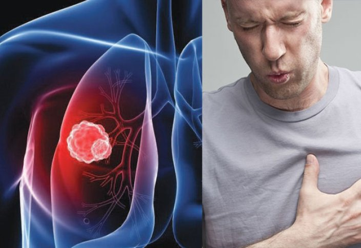 Симптомы рака легкого, симптомы онкологии, боль в груди, боль в грудной клетке, болит легкое