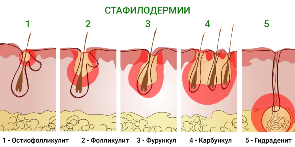 Cтадии развития гидраденита