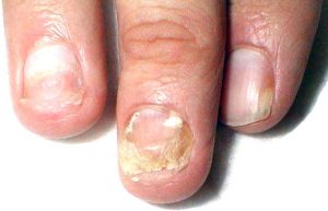 onychomycosis-300x193.jpg onychomycosis-300x193.jpg
