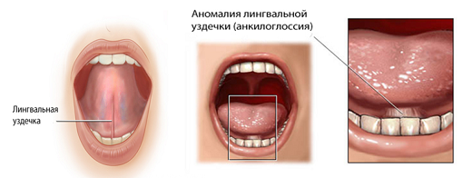 Иллюстрация к разделу «Короткая уздечка языка»