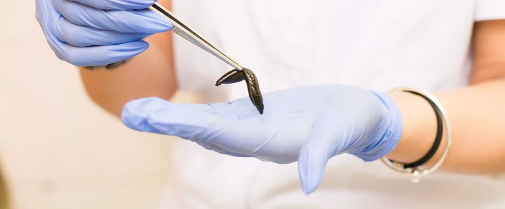 Гирудотерапия