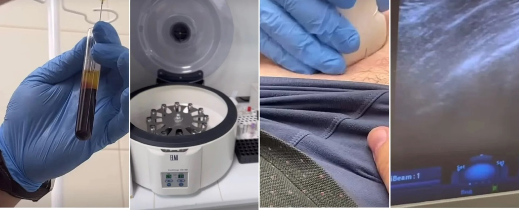 prp терапия в Балашихе плазмотерапия в балашихе