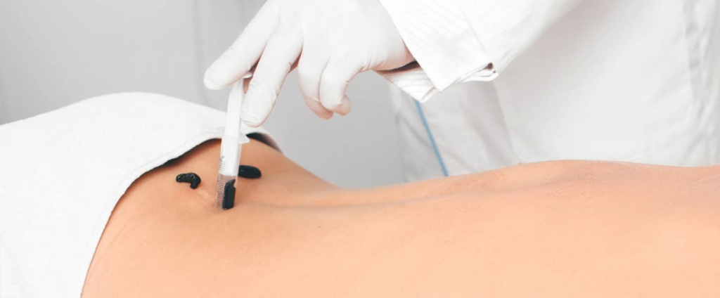 Гирудотерапия