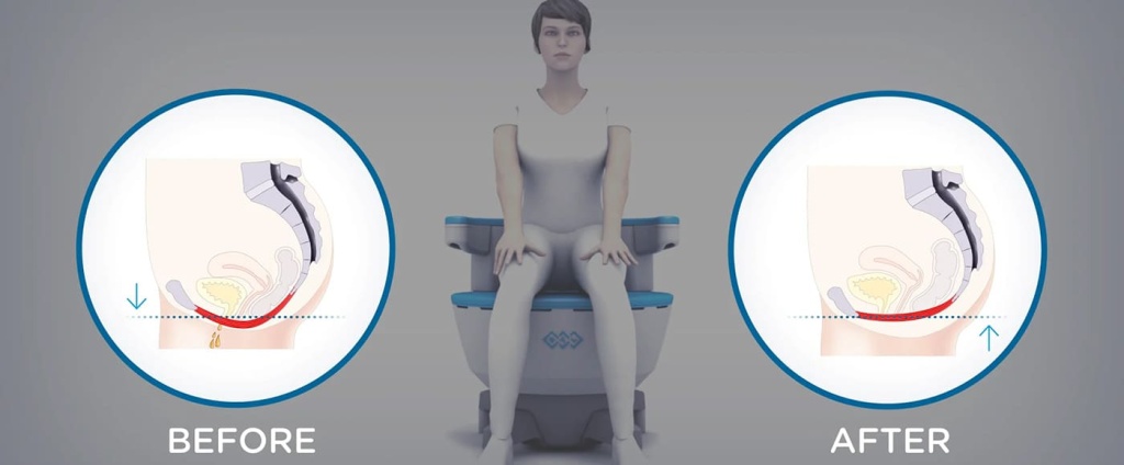 Электромагнитная стимуляция мышц тазового дна