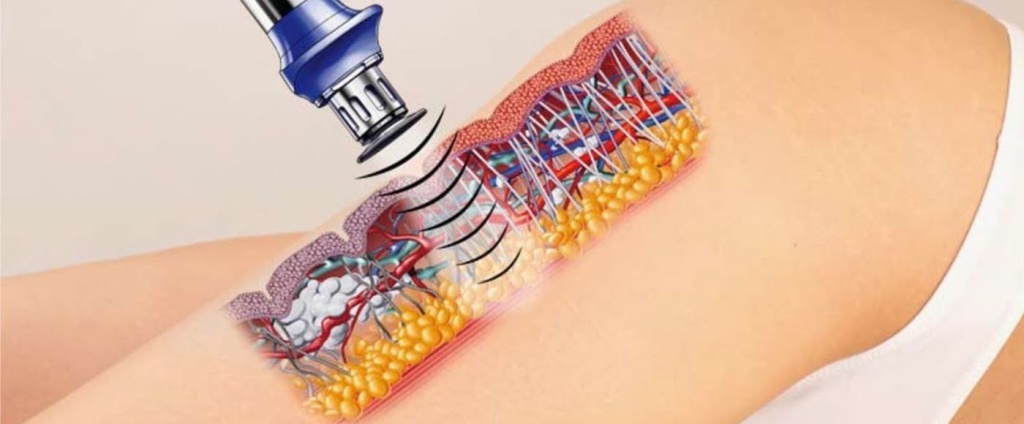 Ударно-волновая терапия