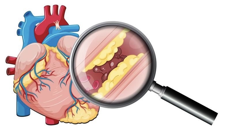 Атеросклероз: причины, опасности и лечение в Доктор Боголюбов 