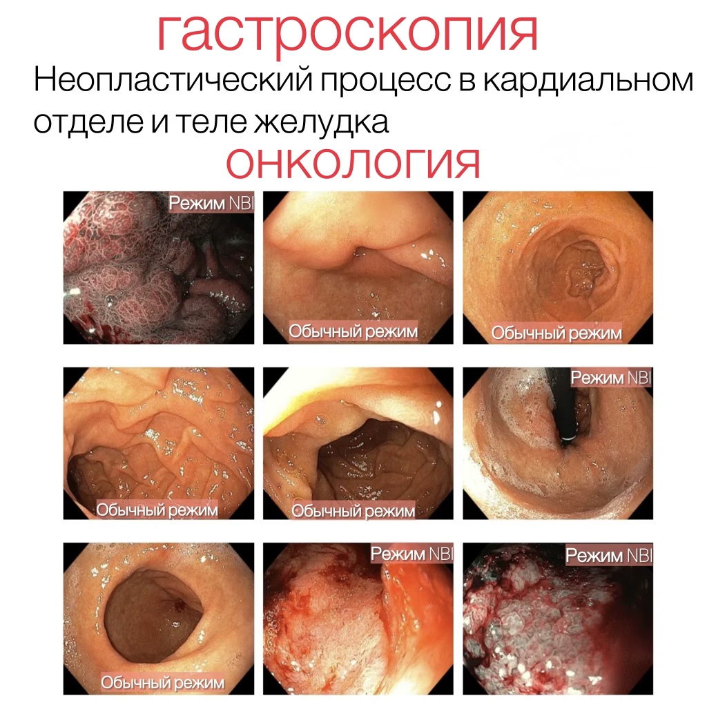 Неопластический процесс в кардиальном отделе желудка