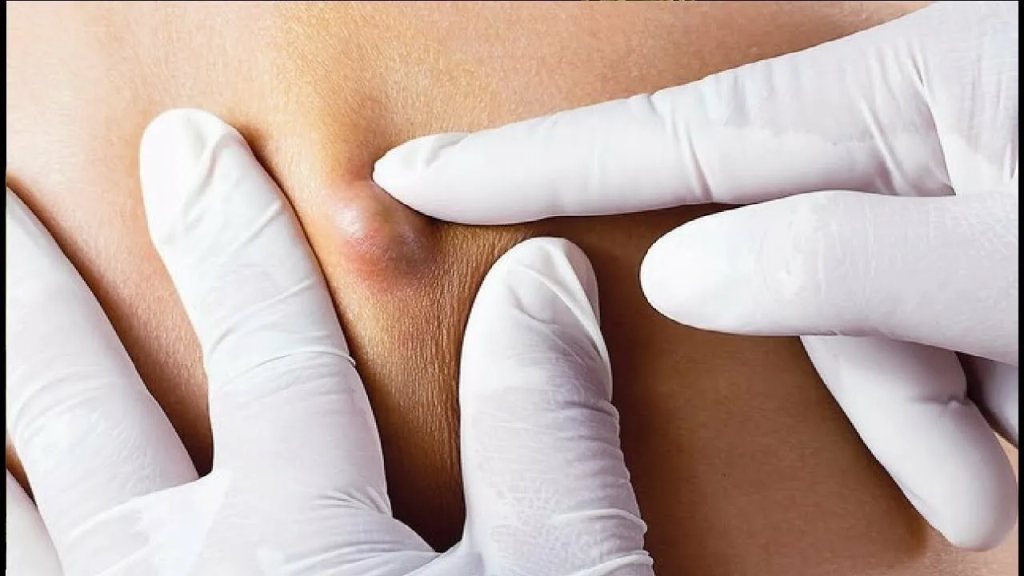 Как выглядит гидраденит