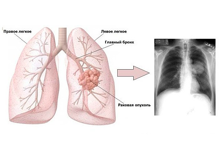 Рентген легких в Балашихе, диагностика рака в Балашихе, диагностика рака легкого