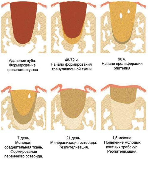 этапы заживления лунки после удаления зуба