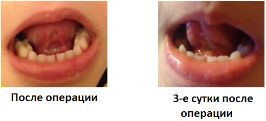 Иллюстрация к разделу «Короткая уздечка языка»