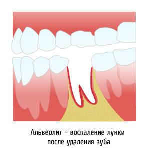 Перфорация гайморовой пазухи при удалении зуба