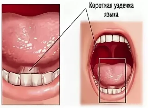 Короткая уздечка языка